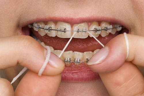 braces-flossing-1a.jpg